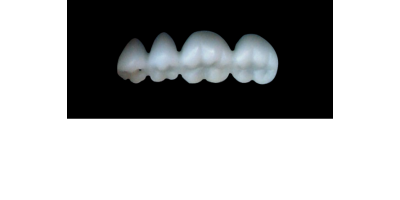 Cod.S4LOWER RIGHT : 15x  posterior solid (not hollow) wax bridges, X-SMALL, (44-47) , with precarved occlusion to Cod.S4UPPER RIGHT,and compatible to Cod.E4LOWER RIGHT (hollow), (44-47)